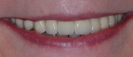 dental implants northern ireland