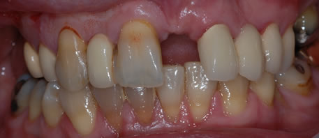 dental implants northern ireland