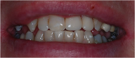 dental implants northern ireland