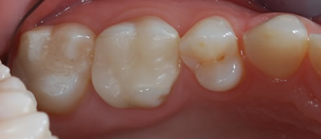 dental implants northern ireland