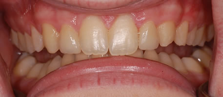 dental implants northern ireland
