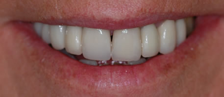 dental implants northern ireland