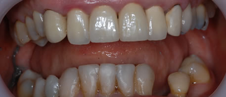 dental implants northern ireland