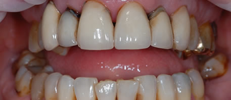 dental implants northern ireland
