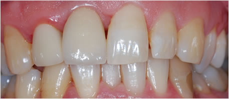 dental implants northern ireland