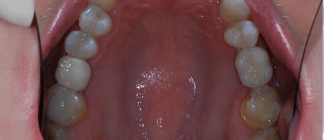 dental implants northern ireland