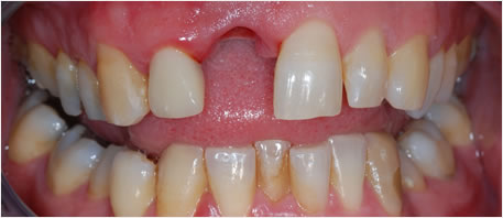 dental implants northern ireland