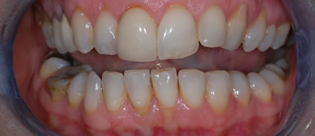 veneers northern ireland