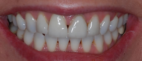 porcelain veneers northern ireland