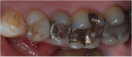 dental implants northern ireland