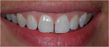 tooth whitening northern ireland