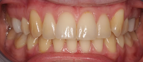 whitening northern ireland